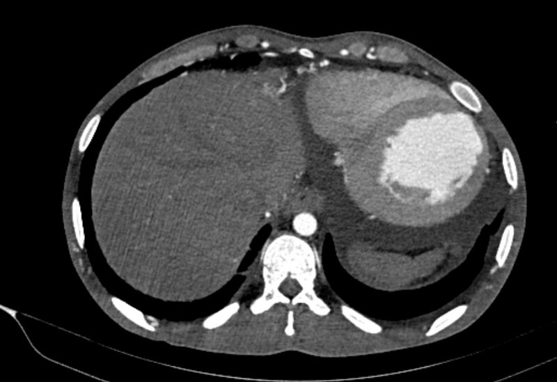 File:Coarctation of aorta with aortic valve stenosis (Radiopaedia 70463-80574 A 200).jpg