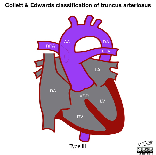 File:Collett and Edwards classification of truncus arteriosus (diagram) (Radiopaedia 51895-57733 D 1).png