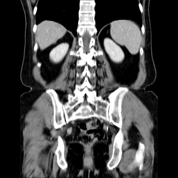 File:Colon carcinoma with hepatic metastases (Radiopaedia 29477-29961 B 33).jpg