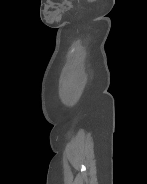 File:Colonic pseudo-obstruction (Radiopaedia 79752-92980 C 71).png