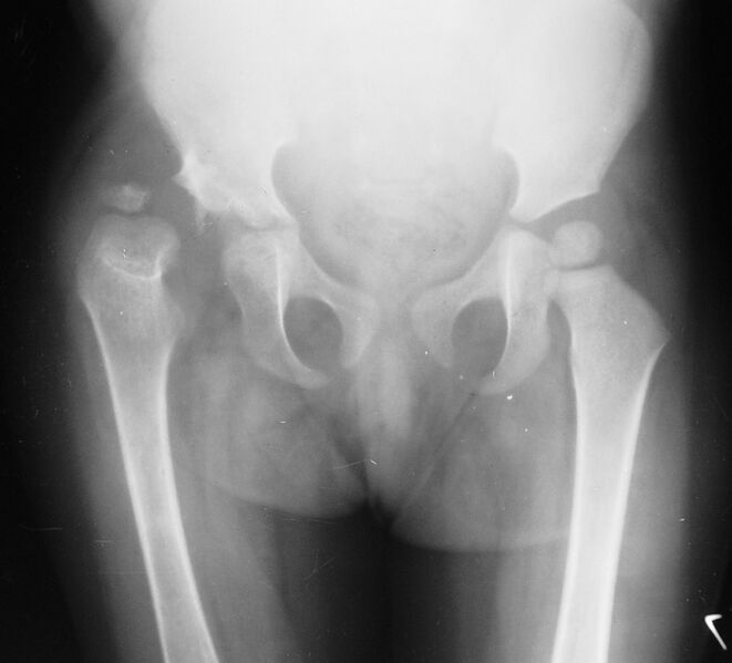 File:Developmental dysplasia of the hip (Radiopaedia 54455).jpg