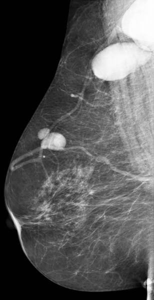 File:Lymphoma breast nodes (Radiopaedia 18780).jpg