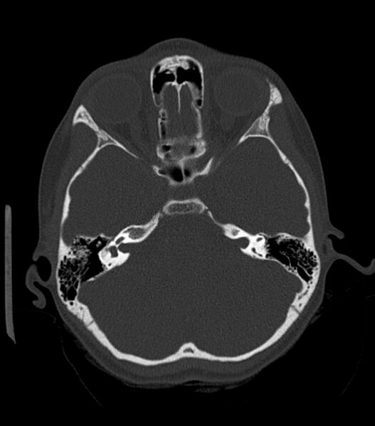 File:Nasoorbitoethmoid fracture (Radiopaedia 90044-107205 Axial bone window 84).jpg