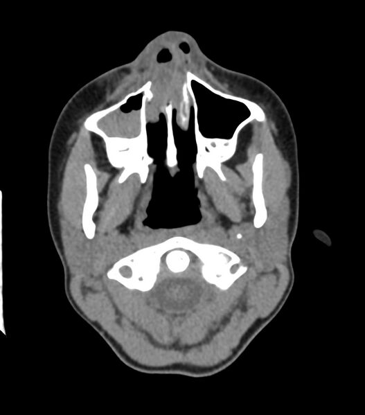 File:Nasoorbitoethmoid fracture (Radiopaedia 90044-107205 Axial non-contrast 111).jpg