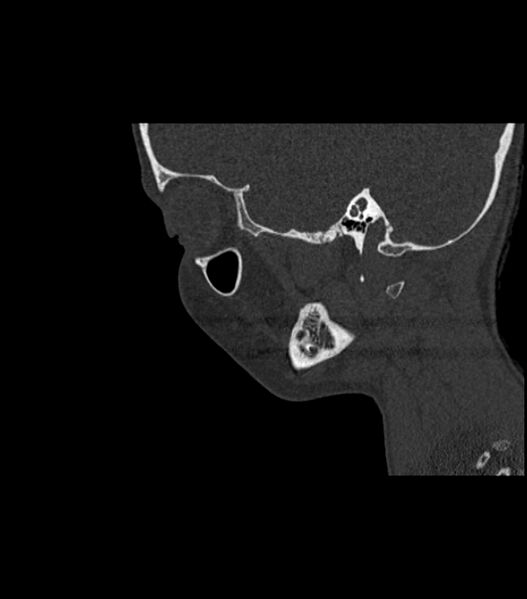 File:Nasoorbitoethmoid fracture (Radiopaedia 90044-107205 Sagittal bone window 42).jpg