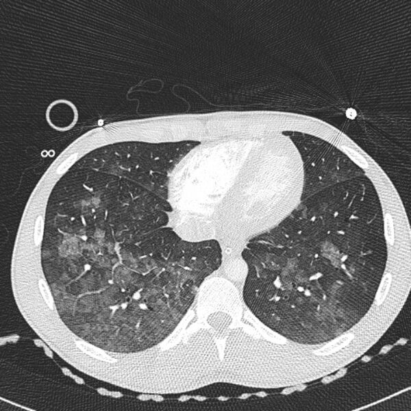 File:Near drowning (pulmonary edema) (Radiopaedia 24685-24958 lung window 61).jpg