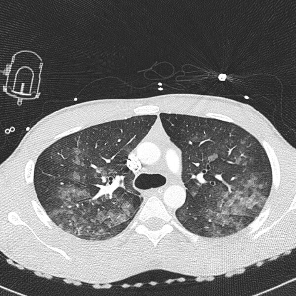 File:Near drowning (pulmonary edema) (Radiopaedia 24685-24958 lung window 8).jpg