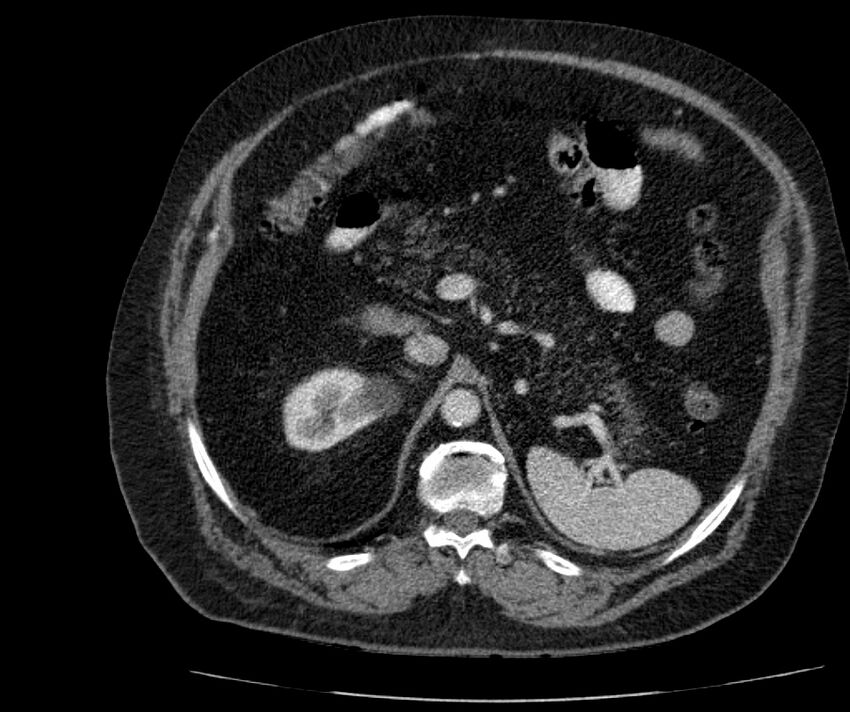 Nephroptosis with inguinal hernia containing perirenal fat (Radiopaedia 56632-63391 C 111).jpg