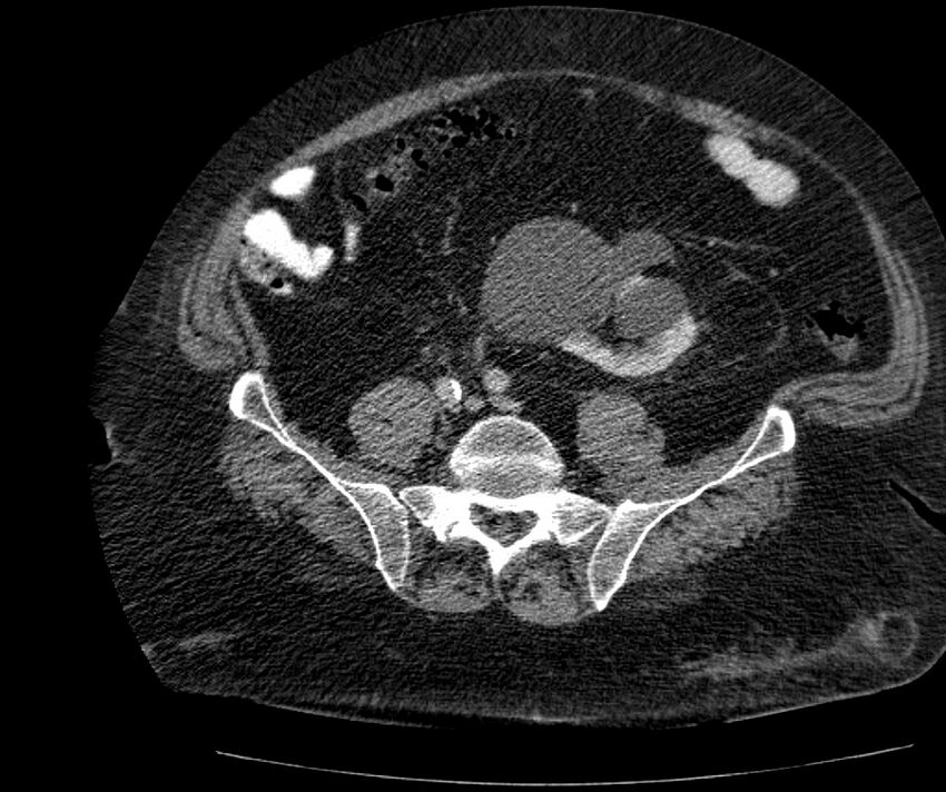Nephroptosis with inguinal hernia containing perirenal fat (Radiopaedia 56632-63391 C 243).jpg