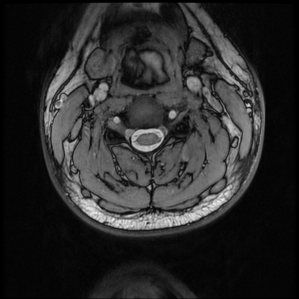 File:Neurofibromatosis type 2 (Radiopaedia 44936-48837 Axial Gradient Echo 29).png