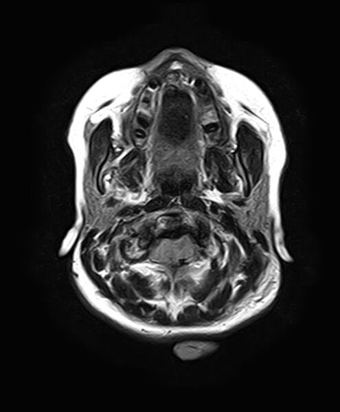 File:Neurofibromatosis type 2 (Radiopaedia 66211-75401 Axial FLAIR 6).jpg