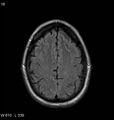 Neurosarcoidosis (Radiopaedia 10930-11351 Axial FLAIR 16).jpg
