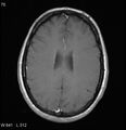 Neurosarcoidosis (Radiopaedia 10930-17204 Axial T1 C+ 13).jpg