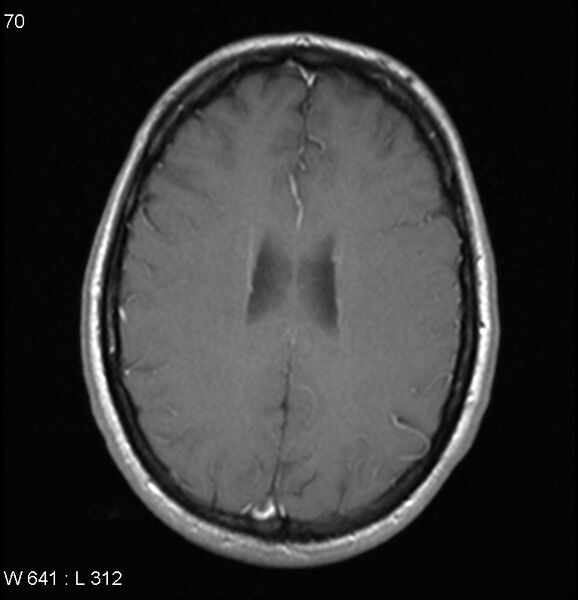 File:Neurosarcoidosis (Radiopaedia 10930-17204 Axial T1 C+ 13).jpg