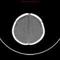 Non-accidental injury - bilateral subdural with acute blood (Radiopaedia 10236-10765 Axial non-contrast 18).jpg