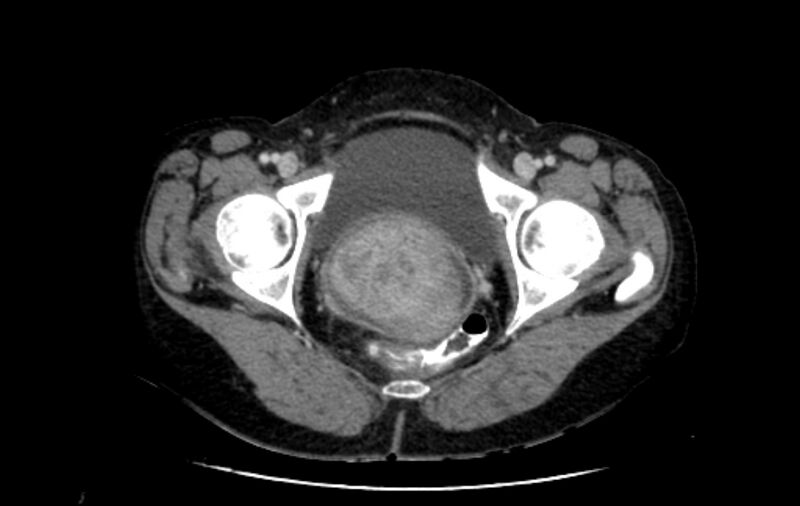 File:Non-puerperal uterine inversion (Radiopaedia 78343-91094 A 66).jpg