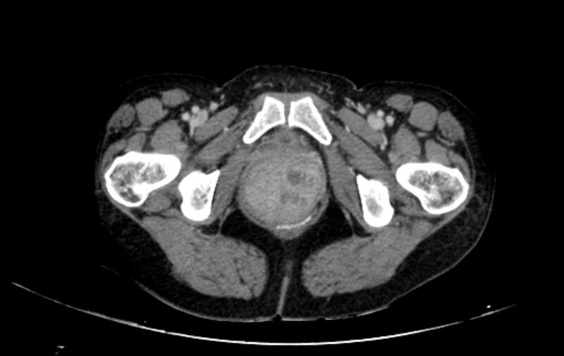 File:Non-puerperal uterine inversion (Radiopaedia 78343-91094 A 87).jpg