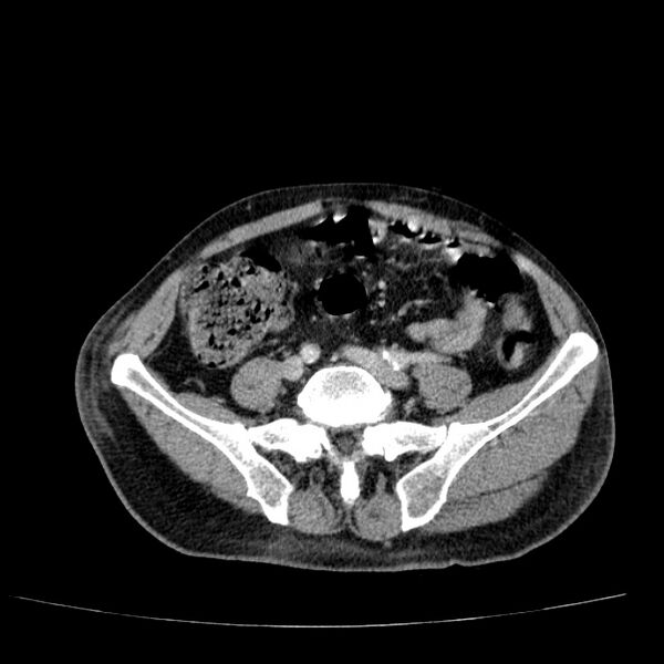 File:Non small-cell lung cancer (Radiopaedia 24467-24769 C+ delayed 94).jpg