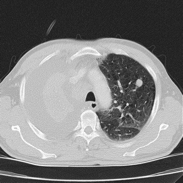 File:Non small-cell lung cancer (Radiopaedia 24467-24769 lung window 13).jpg