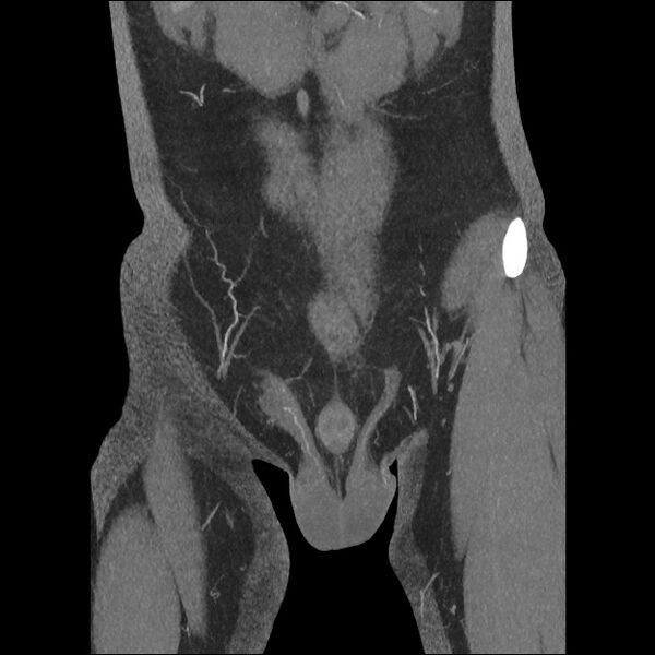 File:Normal CT angiogram of pelvis (Radiopaedia 45390-49430 B 12).jpg