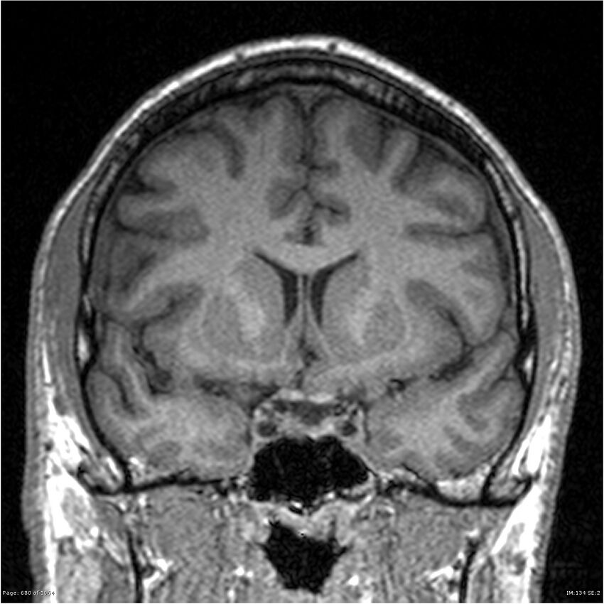 Normal brain MRI (non-focal epilepsy protocol) (Radiopaedia 38571-40700 Coronal T1 66).jpg