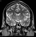 Normal coronal brain (Radiopaedia 6676-7910 Coronal T2 16).jpg