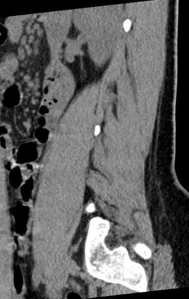 File:Normal lumbar spine CT (Radiopaedia 46533-50986 C 23).png