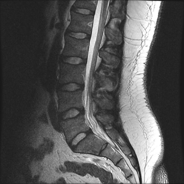 File:Normal lumbar spine MRI (Radiopaedia 43051-46311 Sagittal T2 10).jpg