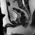 Normal prostate (MRI) (Radiopaedia 29986-30535 Sagittal T2 12).jpg