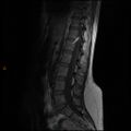 Normal spine MRI (Radiopaedia 77323-89408 Sagittal T1 8).jpg