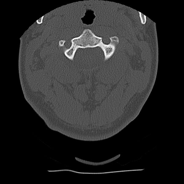 File:Normal trauma spine imaging (Radiopaedia 31753-32686 Axial bone window 19).jpg