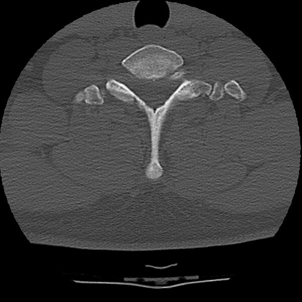 File:Normal trauma spine imaging (Radiopaedia 31753-32686 Axial bone window 70).jpg