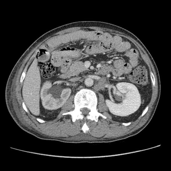 File:Obstructive bladder transitional cell carcinoma (Radiopaedia 9825-10410 A 9).jpg