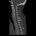 Occipital condyle fracture (Radiopaedia 31755-32691 Sagittal bone window 19).jpg