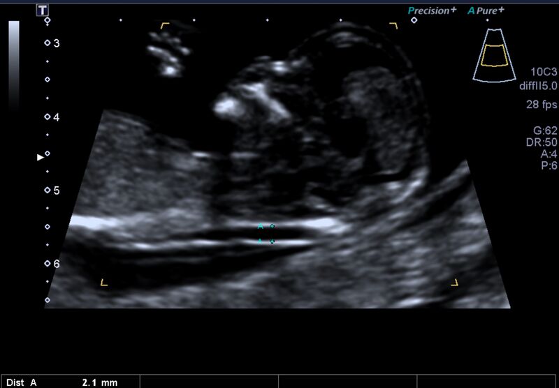 File:1st trimester nuchal-morphology ultrasound (Radiopaedia 44706-48477 General anatomy and NT 5).jpg