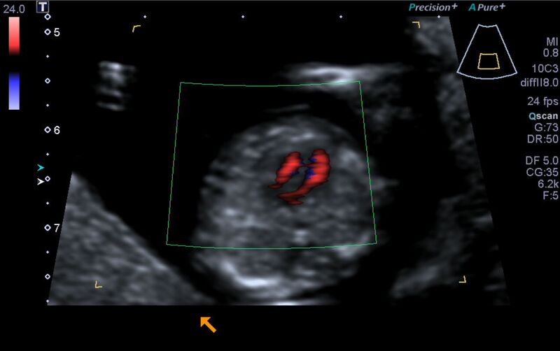 File:1st trimester nuchal-morphology ultrasound (Radiopaedia 44706-48477 Heart views cine with colour 105).jpg
