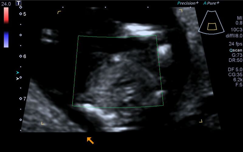 File:1st trimester nuchal-morphology ultrasound (Radiopaedia 44706-48477 Heart views cine with colour 144).jpg