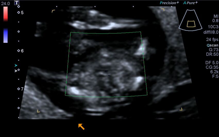 1st trimester nuchal-morphology ultrasound (Radiopaedia 44706-48477 Heart views cine with colour 210).jpg