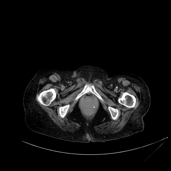 File:Abdominal aortic aneurysm - impending rupture (Radiopaedia 19233-19246 Axial non-contrast 132).jpg