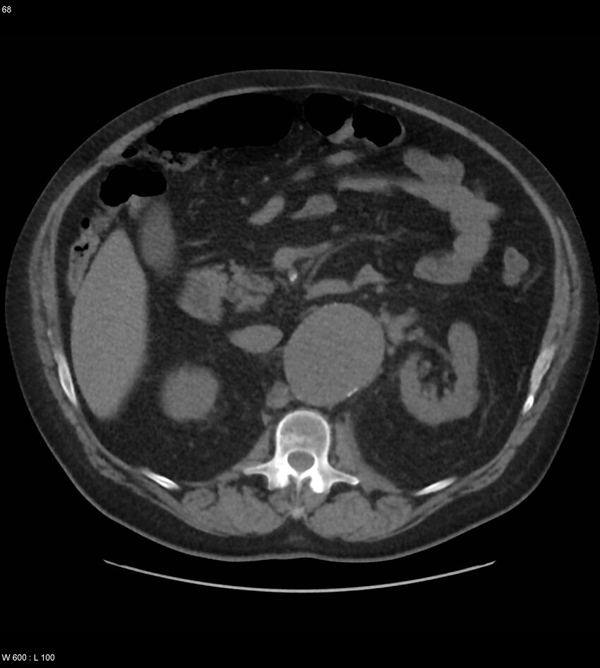 Abdominal aortic aneurysm with intramural hematoma then rupture (Radiopaedia 50278-55631 Axial non-contrast 64).jpg