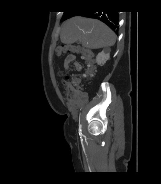 File:Abdominal aortic aneurysm with thrombus fissuration (Radiopaedia 46218-50618 Sagittal C+ arterial phase 13).jpg