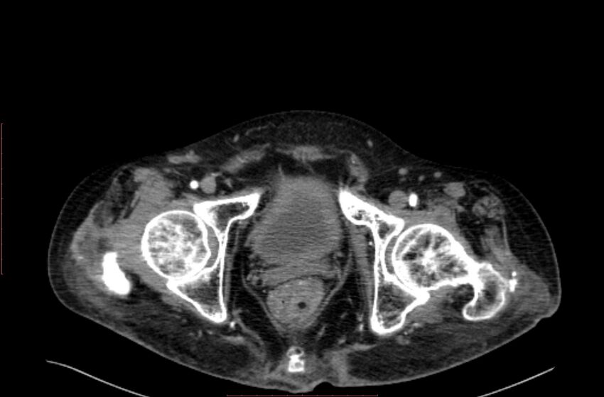 Abdominal aortic interposition tube graft and aneurysm thrombosis (Radiopaedia 71438-81857 Axial C+ arterial phase 236).jpg