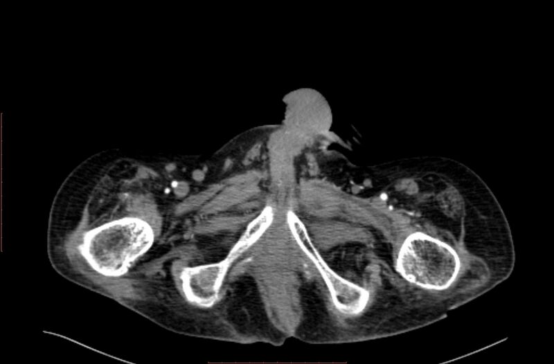File:Abdominal aortic interposition tube graft and aneurysm thrombosis (Radiopaedia 71438-81857 Axial C+ arterial phase 266).jpg