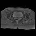 Abdominal wall endometriosis (Radiopaedia 83702-98847 H 12).jpg