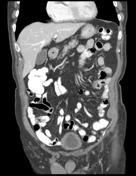 File:Abdominal wall metastasis from colorectal carcinoma (Radiopaedia 31016-31717 Coronal C+ portal venous phase 16).jpg