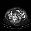 Abdominal wall recurrence after colorectal resection for cancer (Radiopaedia 23444-23523 Axial C+ portal venous phase 14).jpg