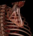 Accessory ossicle on the inferior angle of scapula (Radiopaedia 29222-29620 3D VR bone window 1).jpg