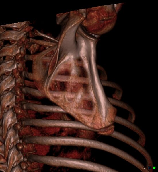 File:Accessory ossicle on the inferior angle of scapula (Radiopaedia 29222-29620 3D VR bone window 1).jpg