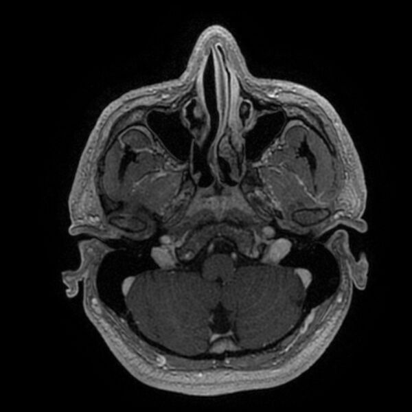 File:Acoustic schwannoma - intracanalicular (Radiopaedia 37247-39024 Axial T1 C+ 47).jpg