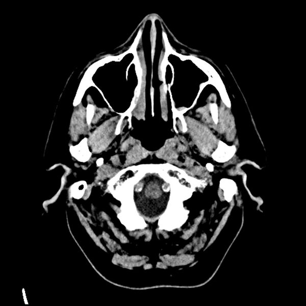 File:Acute A3 occlusion with ACA ischemic penumbra (CT perfusion) (Radiopaedia 72036-82525 Axial non-contrast 1).jpg